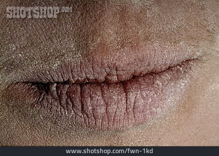 
                Lippen, Mund, Trockene Haut                   