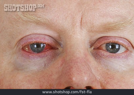 
                Augenkrankheit, Entzündung, Bindehautentzündung                   