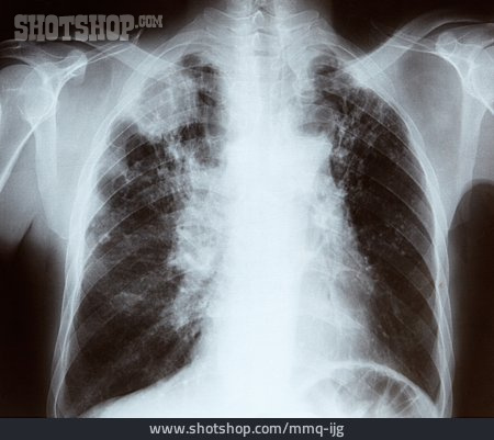 
                Röntgenbild, Lunge                   