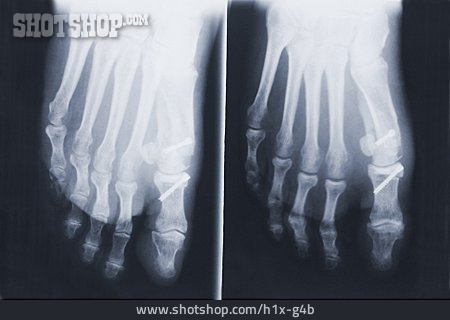 
                Röntgenbild, Fuß, Fußknochen, Hallux Valgus                   