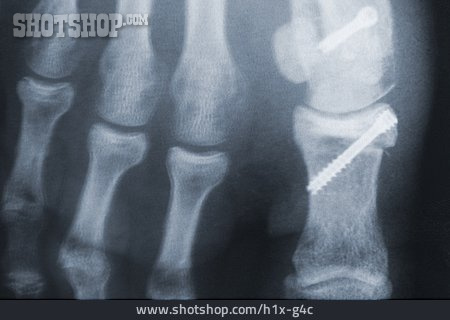 
                Röntgenbild, Fuß, Fußknochen, Hallux Valgus                   