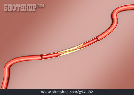 
                Arterie, Arteriosklerose                   