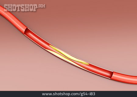 
                Ablagerung, Arterie, Arteriosklerose                   