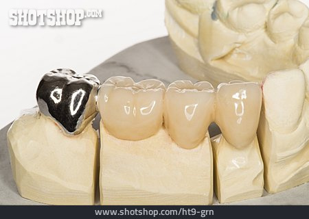 
                Zahnersatz, Zahn, Stiftzahn                   