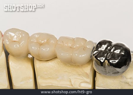 
                Zahnersatz, Zahn, Stiftzahn                   