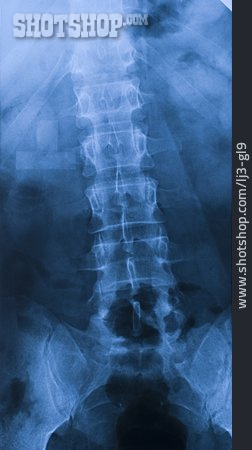 
                Röntgenbild, Wirbelsäule                   