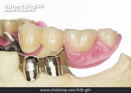 
                Zahnersatz, Zahnprothese, Zahnimplantat                   