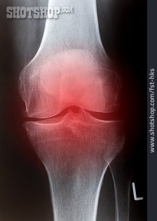 
                Schmerzen, Röntgenbild, Knie, Kniegelenk                   