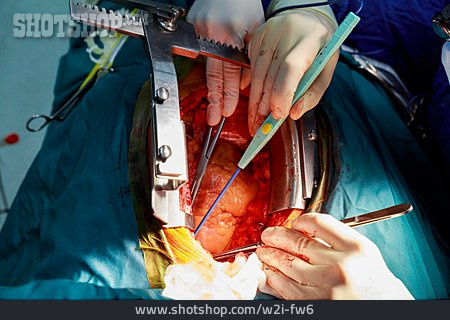 
                Operation, Herzoperation                   