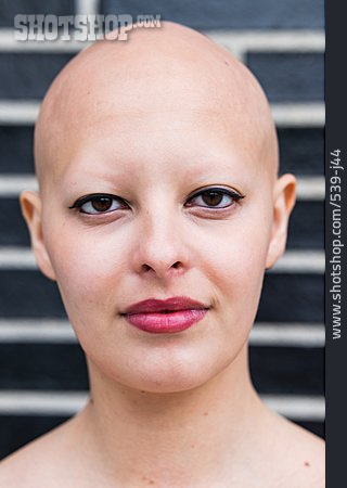 
                Erkrankung, Haarausfall, Alopecia Universalis                   