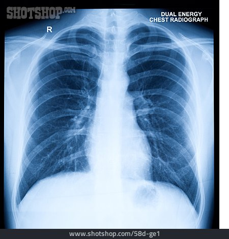 
                Röntgenbild, Lunge, Brustkorb                   
